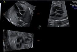 妊娠中期から末期の超音波検査